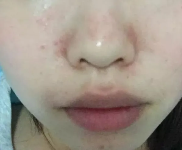 鼻子两侧红血丝怎么办 应对鼻子两侧红血丝的方法