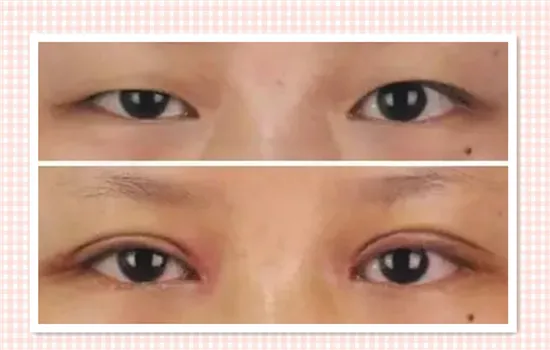眼睑下垂会自己好吗 能自愈的话还要手术有何用