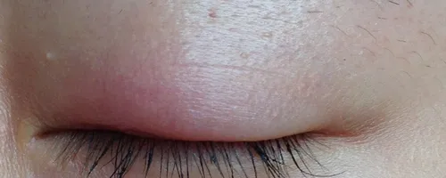 美瞳线消肿的最快方法