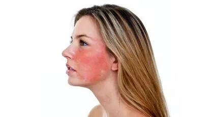 敏感肌脸颊泛红怎么修复 敏感肌怎么修复成正常肌肤