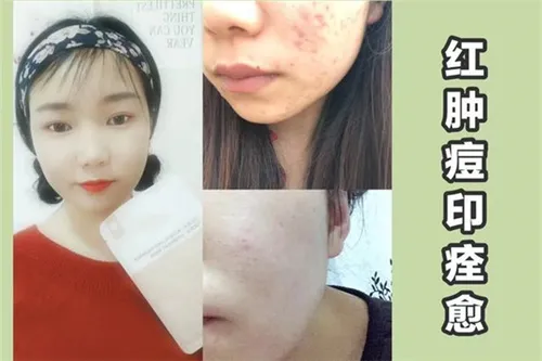 我的皮肤老是长痘痘是什么原因呢