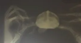 一例中华草龟摔伤临床诊断治疗案例