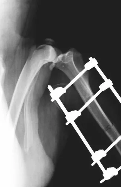 外固定支架在四肢骨骨折中的应用