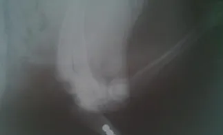 一例关于骨折后治疗延误的案例