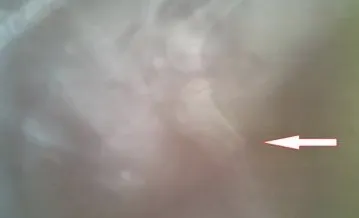一例关于骨折后治疗延误的案例