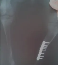 一例关于骨折后治疗延误的案例