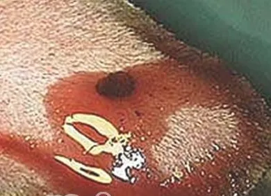 狗狗耳血肿该怎么治疗？