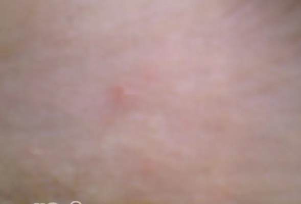 夏季皮肤病多发的原因和对策