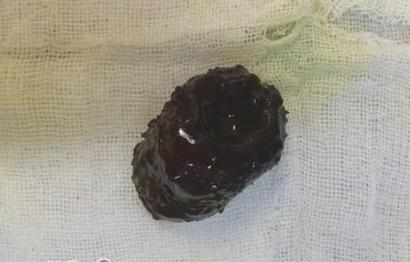 犬异物性肠道阻塞的治疗