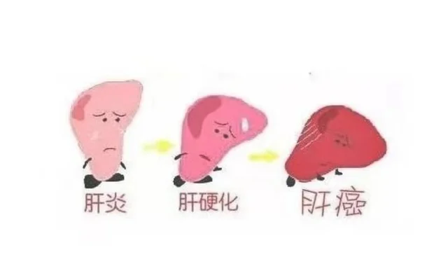 肝炎是大病吗