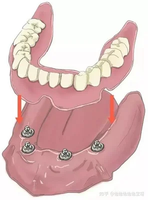 4、种植牙牙周病变