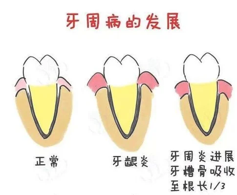 5、牙周病