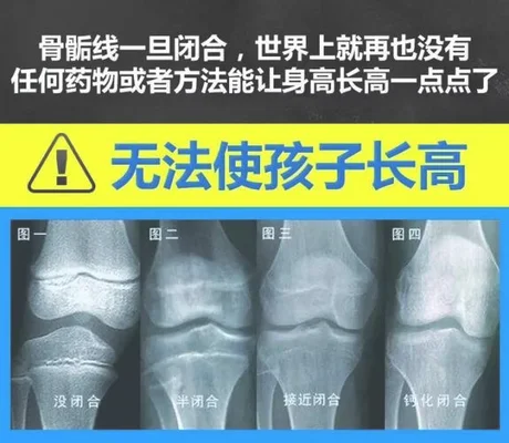 什么是骺软骨？什么是干骺端？有什么区别？