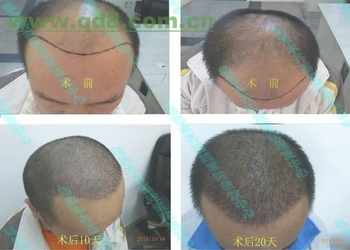 4、植发手术所使用的药物最好在三个月之内就不要服用了。