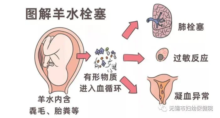 什么情况容易羊水栓塞