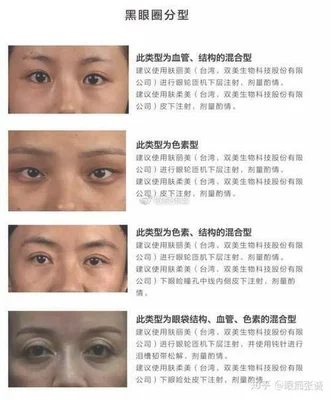 怎样去眼袋和黑眼圈小窍门