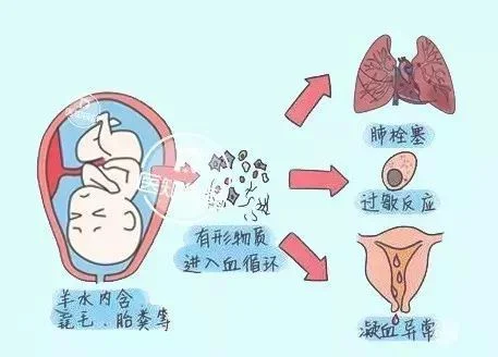 羊水栓塞是怎么引起的