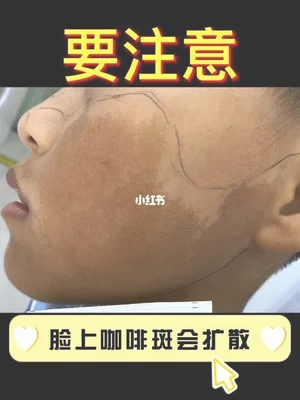 咖啡斑会遗传吗(牛奶咖啡斑会遗传下一代
