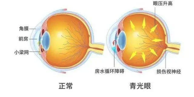 青光眼的症状和表现是什么(青光眼的症状和表现是什么白内障)