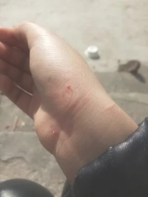 被猫咬了怎么办？教你几招,简单有效!猫狗咬伤处理：立即冲洗伤口,用肥皂水反复清洗冲洗时注意水流方向,从伤口一侧流向另一侧,不可从下往上冲洗清洗完用碘伏消毒伤口内部