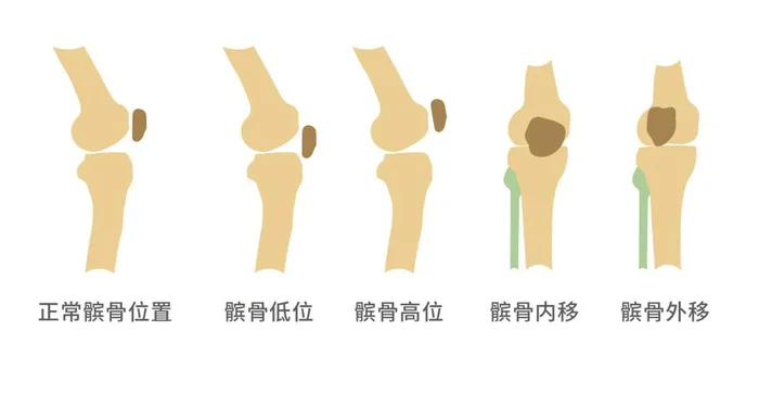 髌骨软骨软化是怎么造成的,髌骨软骨软化