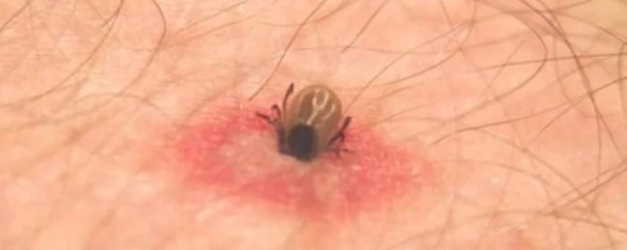 房间里发现了蜱虫还能住吗