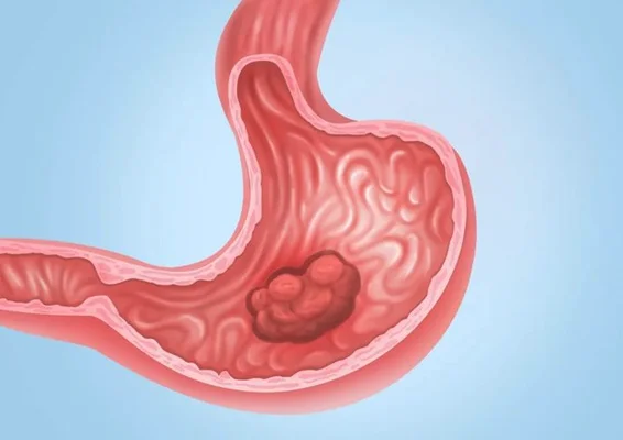 胃癌会在一年内形成吗