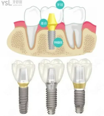 1、种植牙的适应症