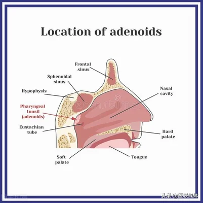 腺样体肥大是什么症状(腺样体肥大是什么症状怎么治)
