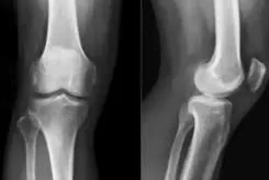 膝盖骨刺的治疗方法 | 这四个小偏方或许是最佳治疗方法