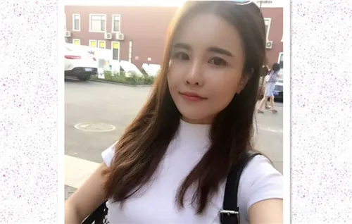 玻尿酸法令纹