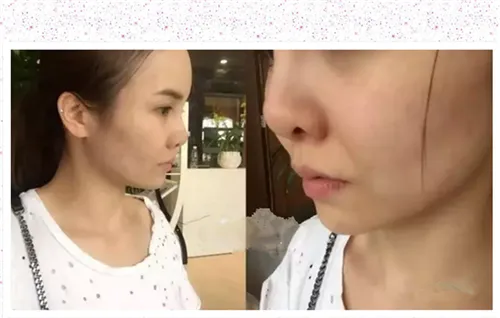 玻尿酸法令纹