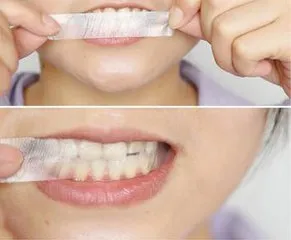 牙齿美白贴片是什么 牙齿美白贴片有几种类型